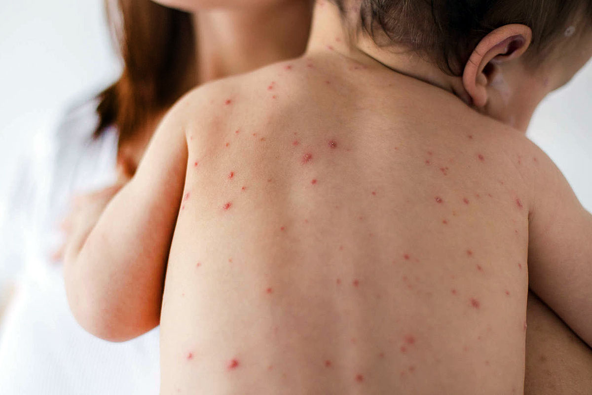 Brote de sarampión en Europa: la OMS apunta a los «antivacunas»