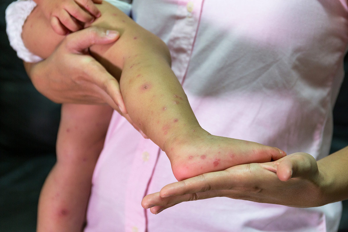 Confirman un caso de sarampión en Vicente López y recomiendan completar la vacunación