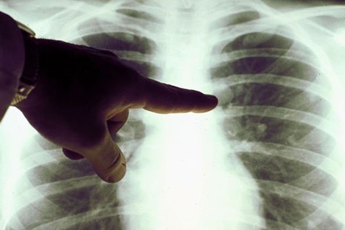Neumonólogos argentinos impulsan un proyecto para mejorar el diagnóstico temprano de cáncer de pulmón