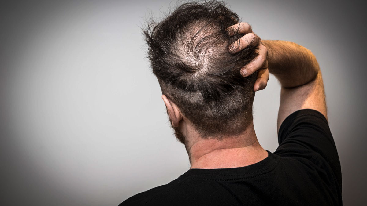 Por qué la pérdida de pelo ocurre en personas cada vez más jóvenes y qué recomiendan los especialistas