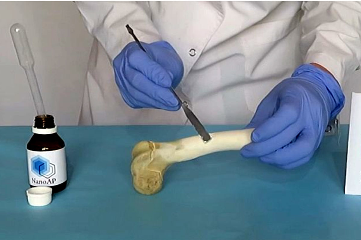 NanoAp: crean un relleno óseo que se degrada cuando crece el hueso natural