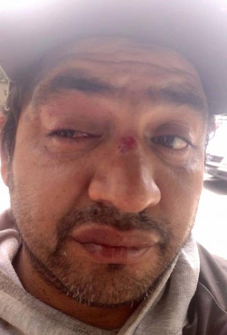 Un manifestante perdió un ojo por un balazo de la policía, en la represión de la marcha de los movimientos sociales