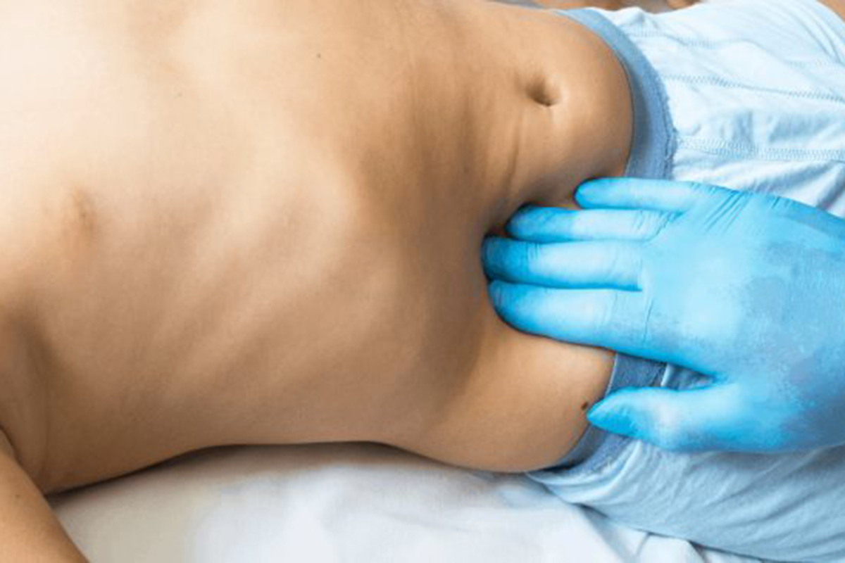 De órgano a foco de alerta: crecen los casos de cáncer de apéndice