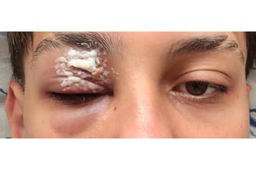 Denuncian que la Policía de la Ciudad hirió en un ojo a un adolescente durante los festejos por el triunfo ante Suiza